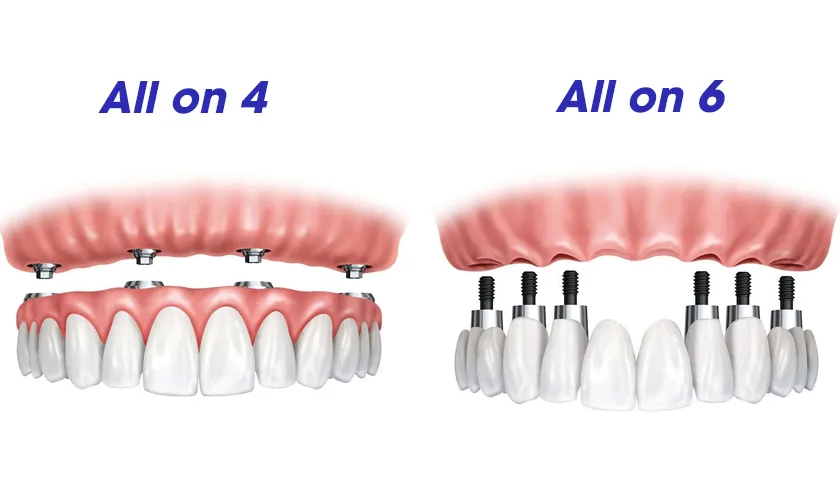 Implant All-on-4 / All-on-6