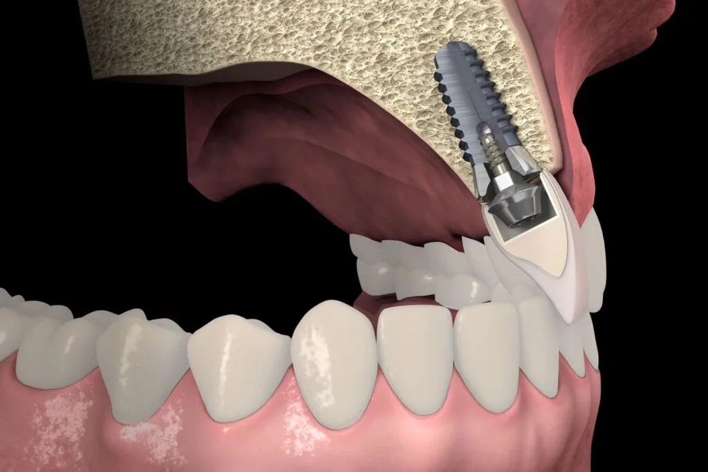 Knochentransplantation