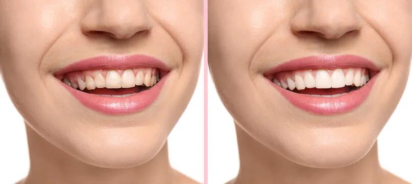 Natural Smile